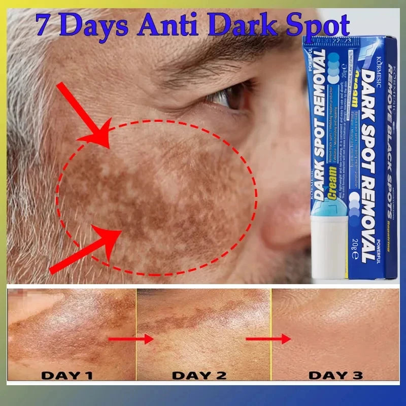 Effective Whitening Freckles Face Cream Remove Melasma Dark Spots Fade Pigmentation Acne Scars Moisturizing Brighten Beauty Care