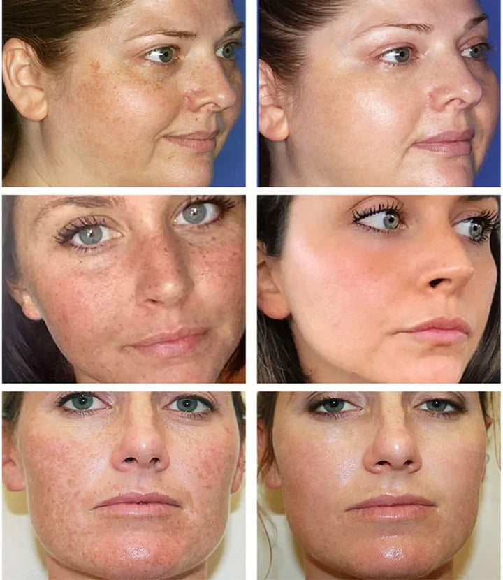 Powerful Spot-removing Whiten Cream Brighten Skin Fast Eliminates Melanin Pigmentation Melasma Dark Spots Moisturize Beauty Gel
