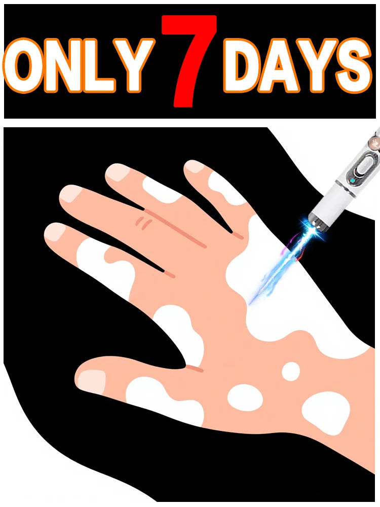 Blue light pen quickly removes vitiligo, a best-selling vitiligo care tool. Halalzen