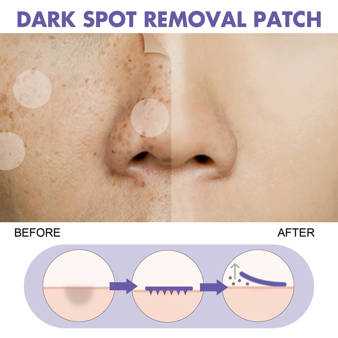 Spot-Removing Patches - For Lightening Facial Dark Spots, Chloasma, Pigmentation And Melanin; Moisturizing Skin. Spot Patches