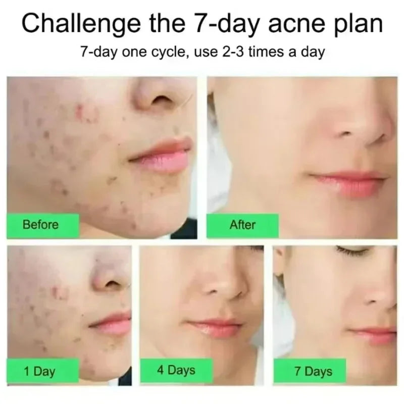 Effective Acne Removal Cream Anti-Acne Repair Redness Pimple Spots Gel Deep Cleaning Pore Oil Control Moisturizing Skin Care 30g
