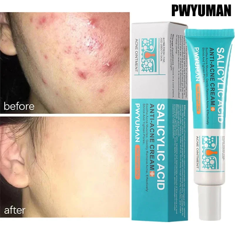 Effective Acne Removal Cream Anti-Acne Repair Redness Pimple Spots Gel Deep Cleaning Pore Oil Control Moisturizing Skin Care 30g