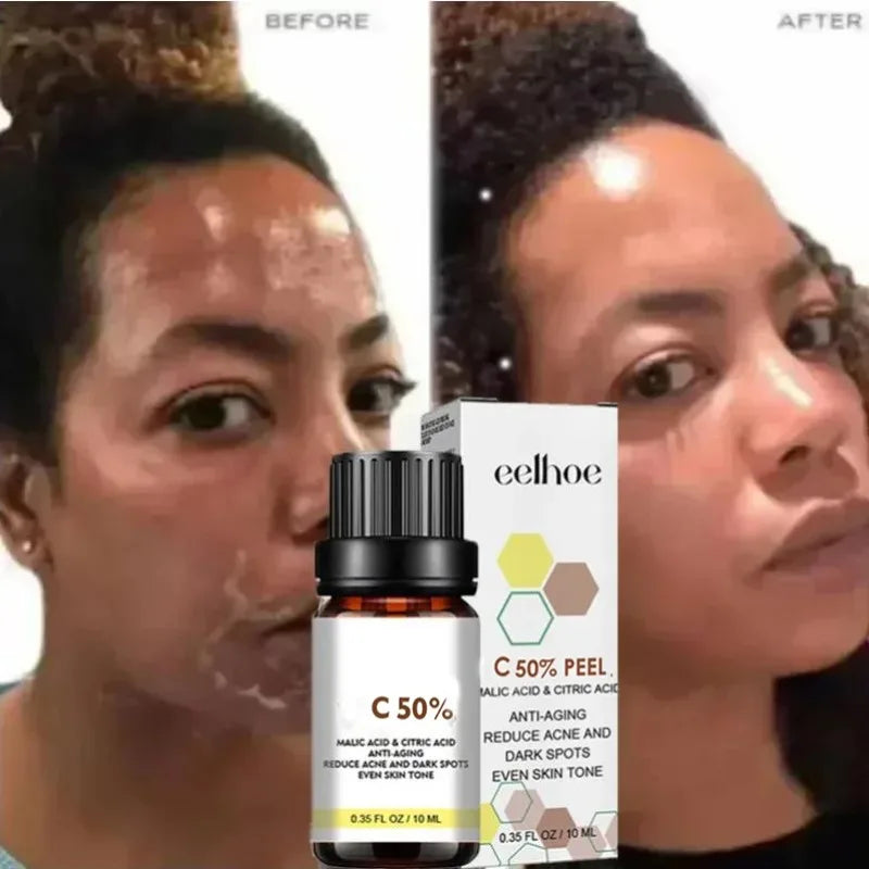 Dilute melanin, acne, 50% TCA, high-quality chemical exfoliation, acidic skin beauty care